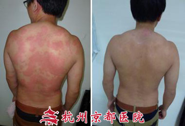 荨麻疹治疗前后对比图