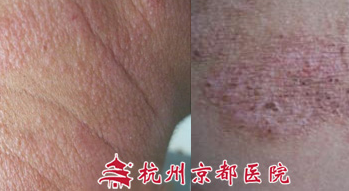 "核素敷贴联合疗法"治疗神经性皮炎0发作