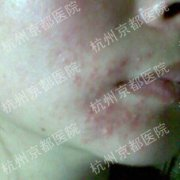 皮肤过敏