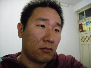 青春痘